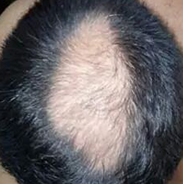 Alopecia antes