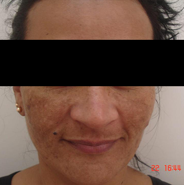 Melasma antes 1