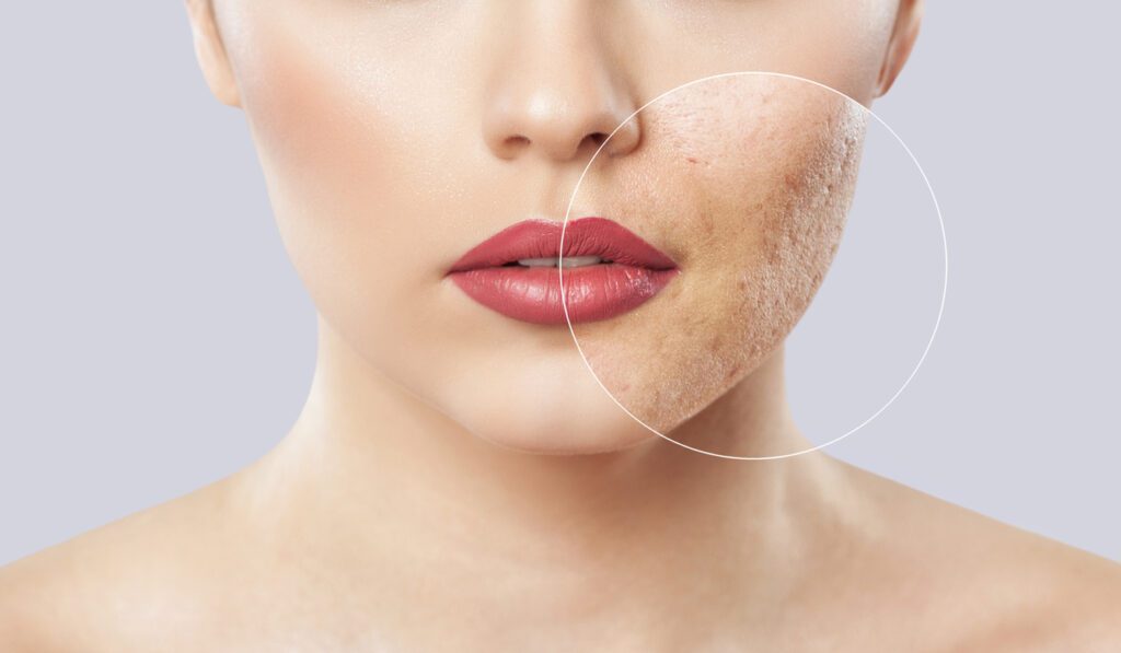 cicatriz de acne tratamentos